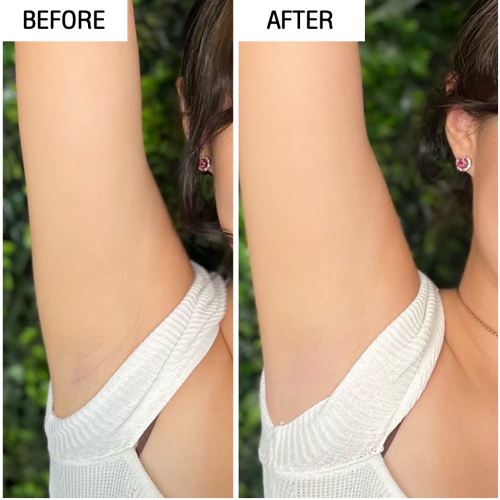 Yag laser